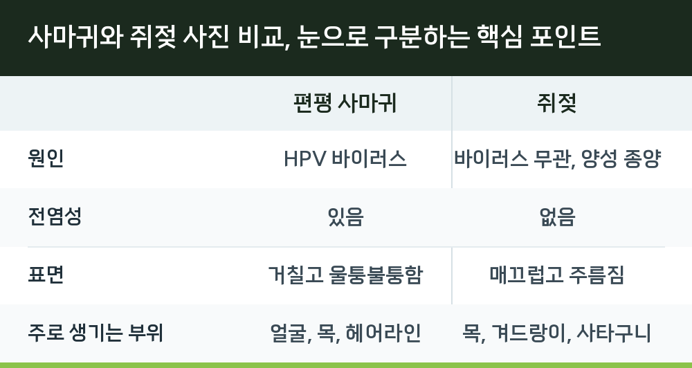 사마귀와 쥐젖 사진 비교, 눈으로 구분하는 핵심 포인트