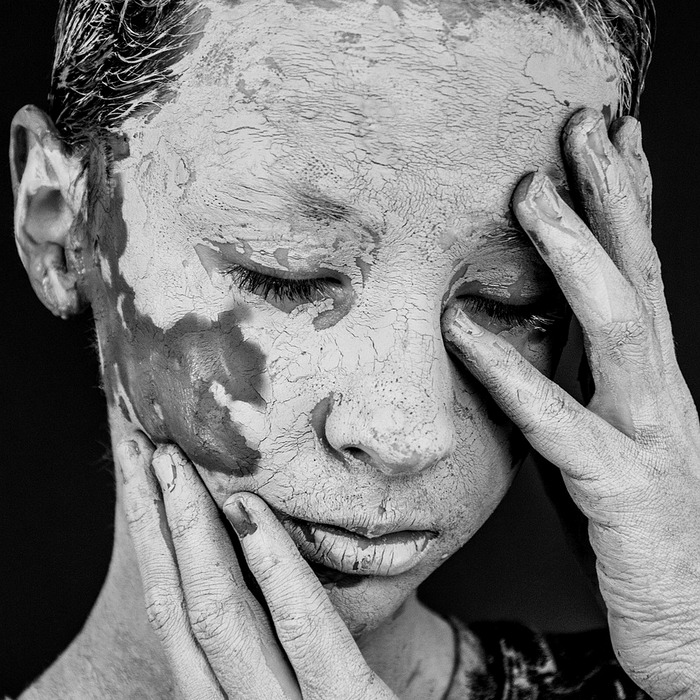 피부 색소 침착